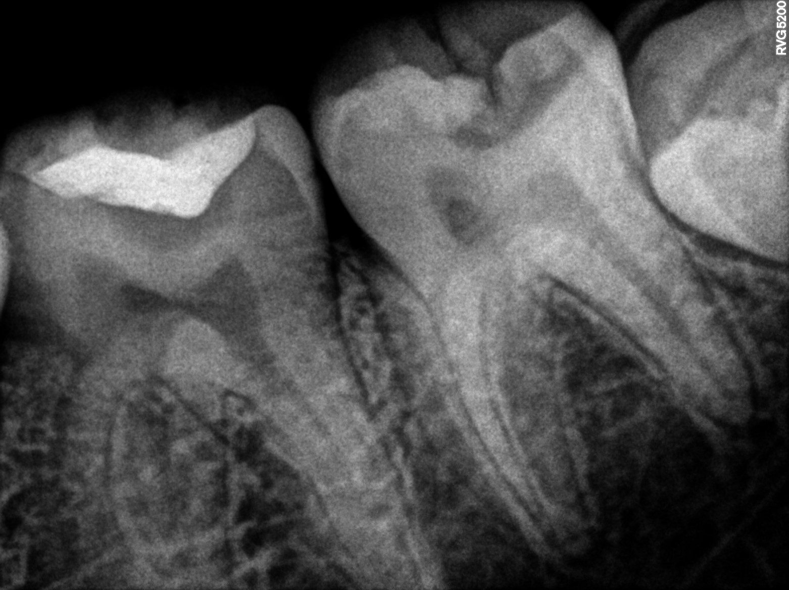 Dental X-ray